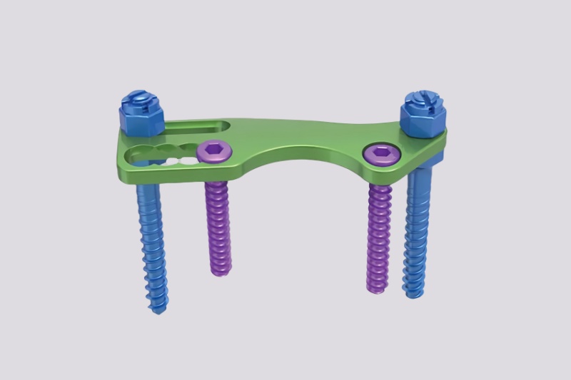 Anterior Thoracic Plate System -CnOrtho