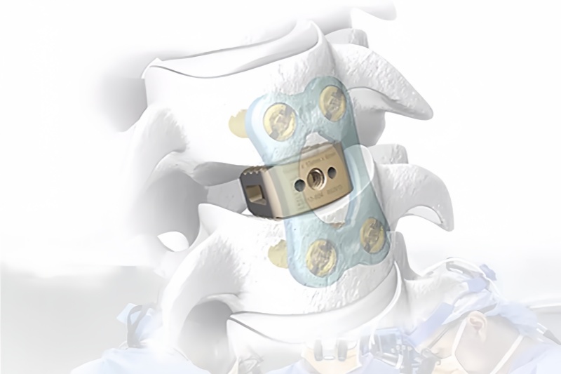 Cervical Peek Cage-II-CnOrtho