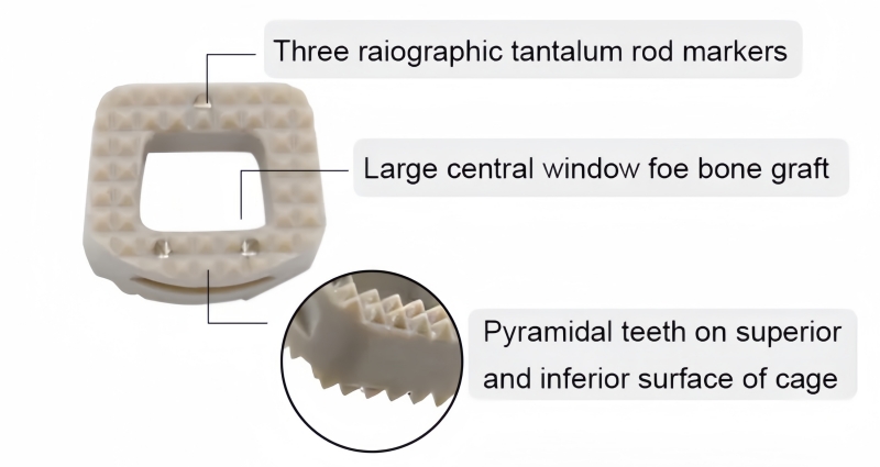 Cervical Peek Cage -CnOrtho