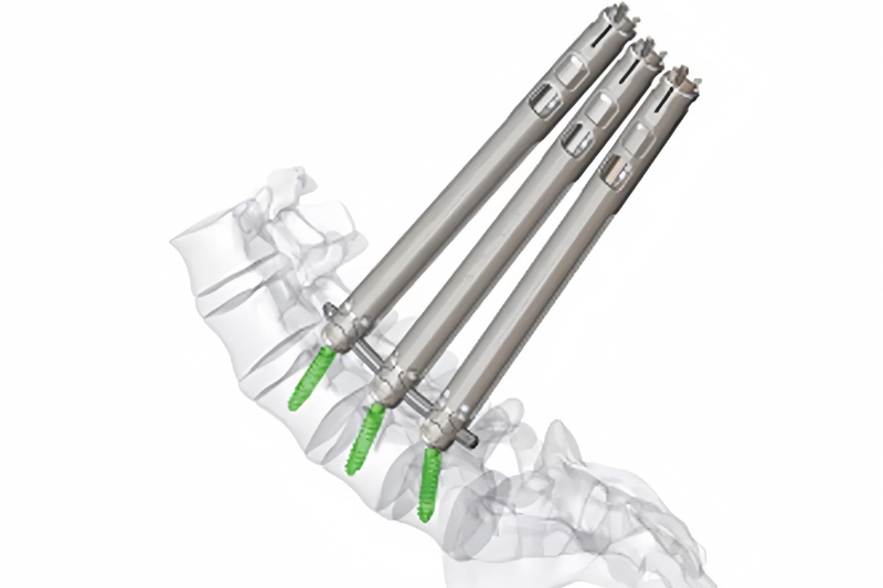 5.5 Minimally Invasive Pedical Screw-CnOrtho