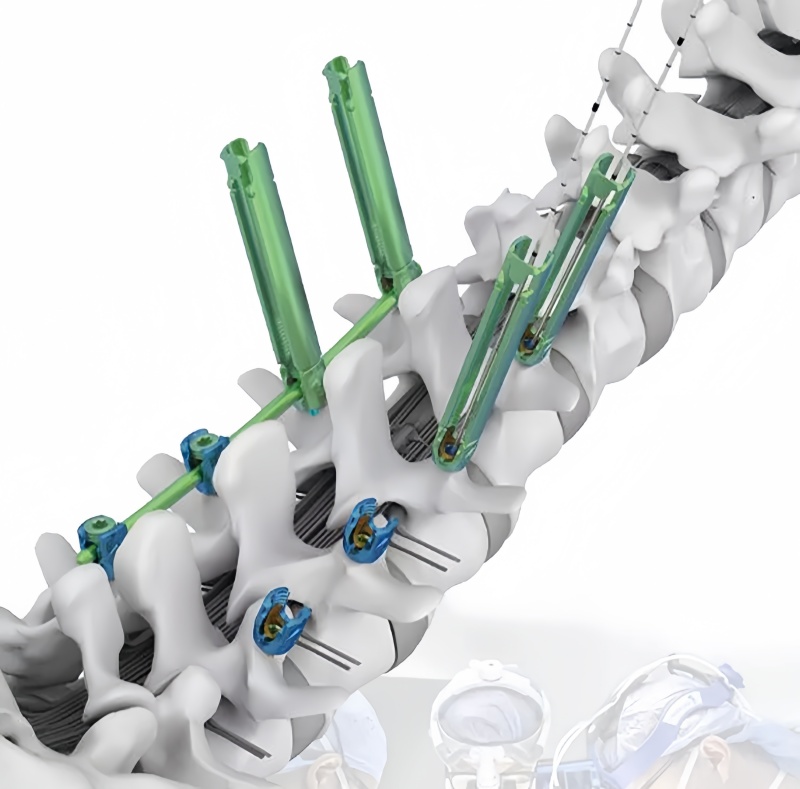 5.5 Minimally Invasive Pedical Screw-CnOrtho
