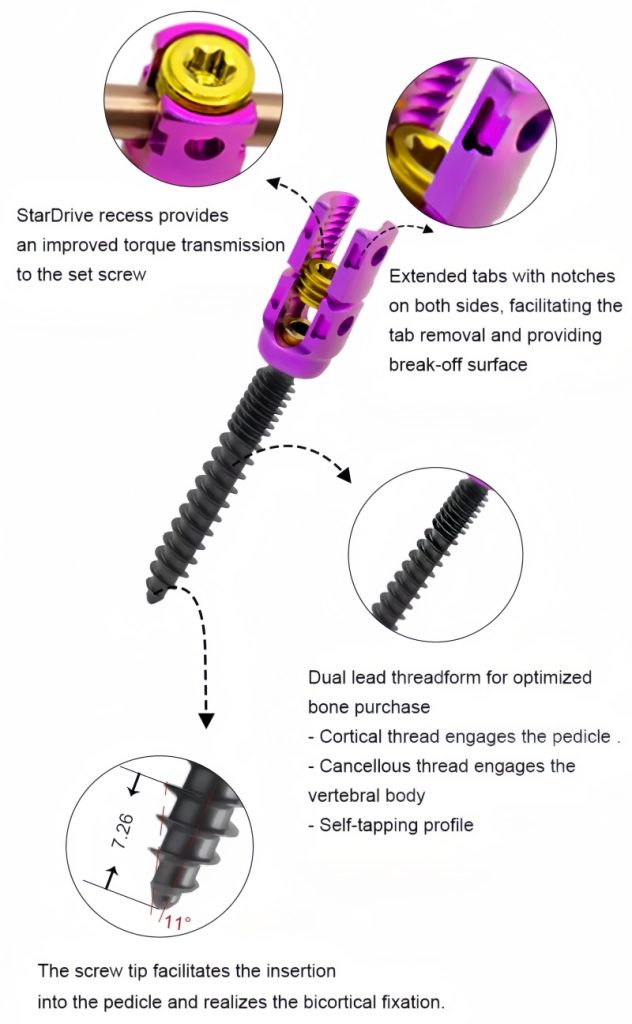 5.5 Spinal Pedicle Screw System -CnOrtho