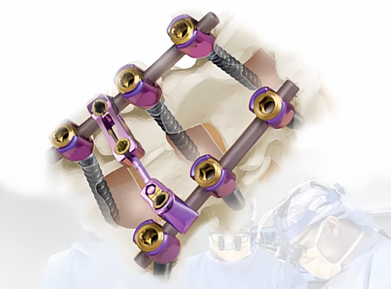 6.0 Spinal Pedicle Screw System-CnOrtho
