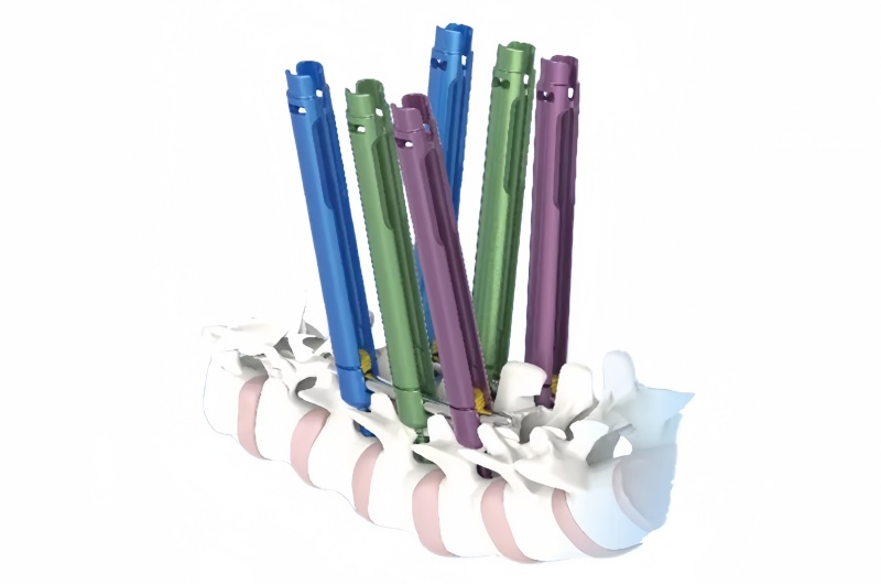 Minimally Invasive Pedical Screw Instrument Set: The Future of Spinal Surgery-CnOrtho