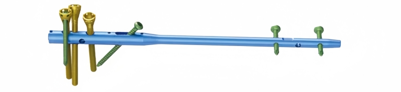 Multi-Loc Humeral Nail: An Innovative Solution for Proximal Humerus Fractures-CnOrtho