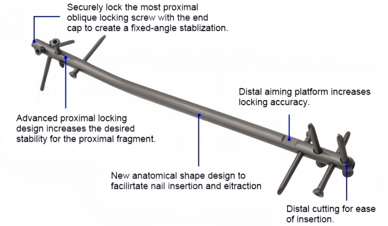 Expert Tibia Nail-CnOrtho