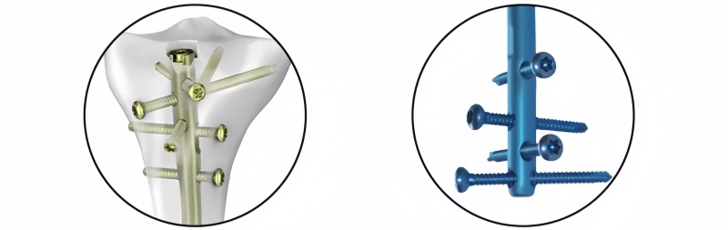 Expert Tibia Nail-CnOrtho