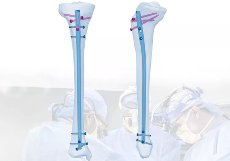 Expert Tibia Nail: A Comprehensive Guide to Understanding the Procedure-CnOrtho