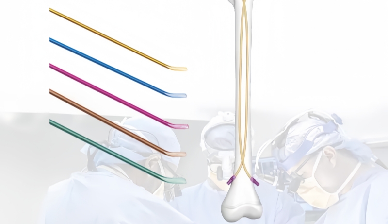 Titanium Elastic Nail: A Revolutionary Orthopedic Implant-CnOrtho