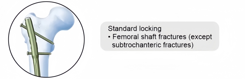 Expert Femoral Nail-CnOrtho
