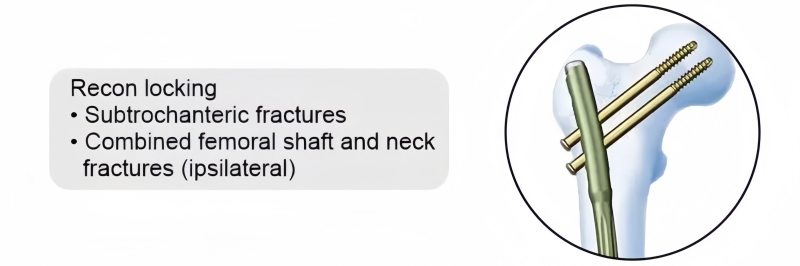 Expert Femoral Nail-CnOrtho