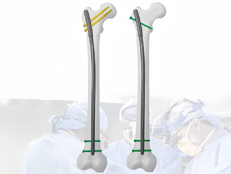 Expert Femoral Nail: Everything You Need to Know-CnOrtho
