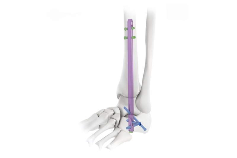 Hindfoot Fusion Ankle Nail-CnOrtho