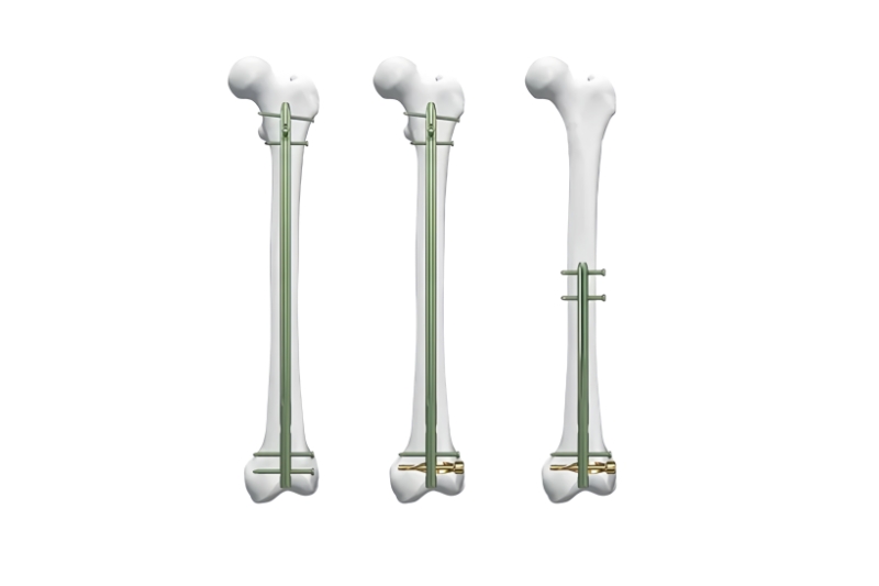 DFN Distal Femur Intramedullary Nail-CnOrtho