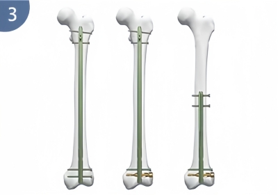 DFN Distal Femur Intramedullary Nail-CnOrtho